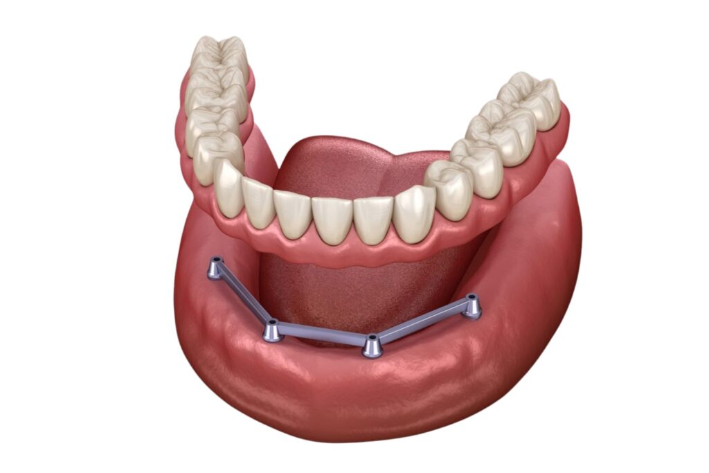 Bar supported denture 4 Implantaten