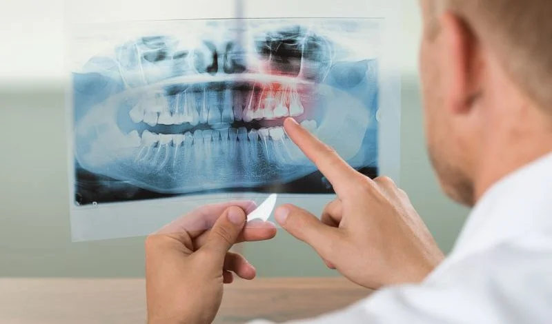 Bone graft