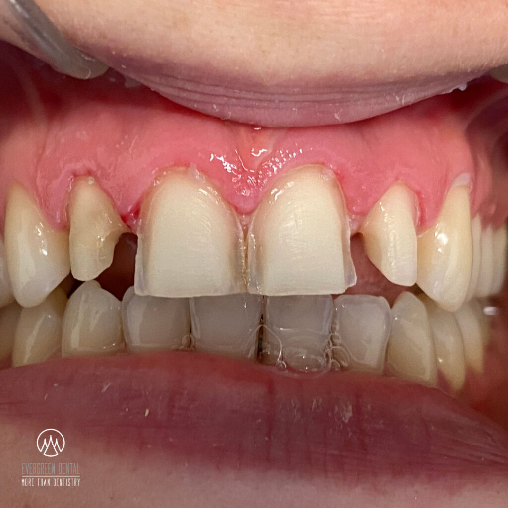 Express Zahnkronen und Brücken