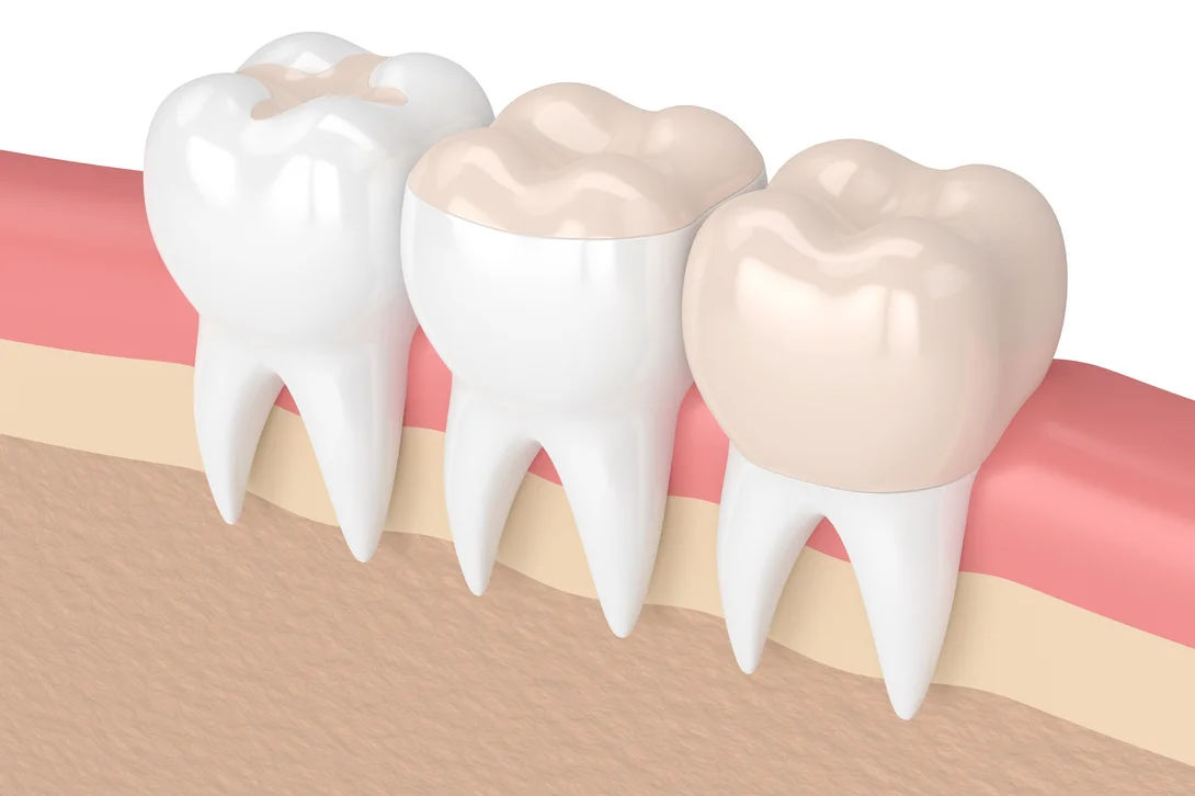 Füllungen - inlay, onlay