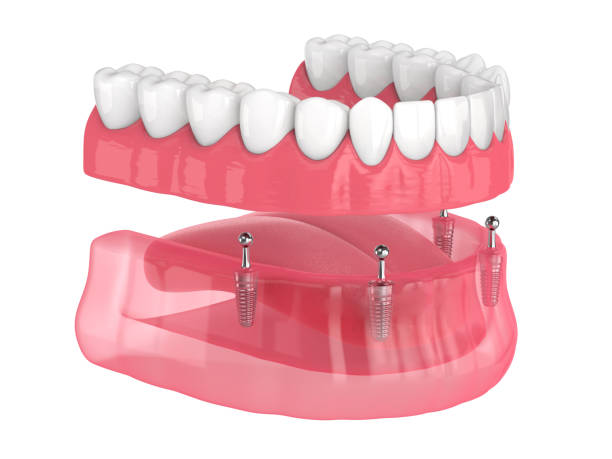 Locator overdenture on 4 Implants